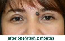 plastic-surgery-blepharoplasty